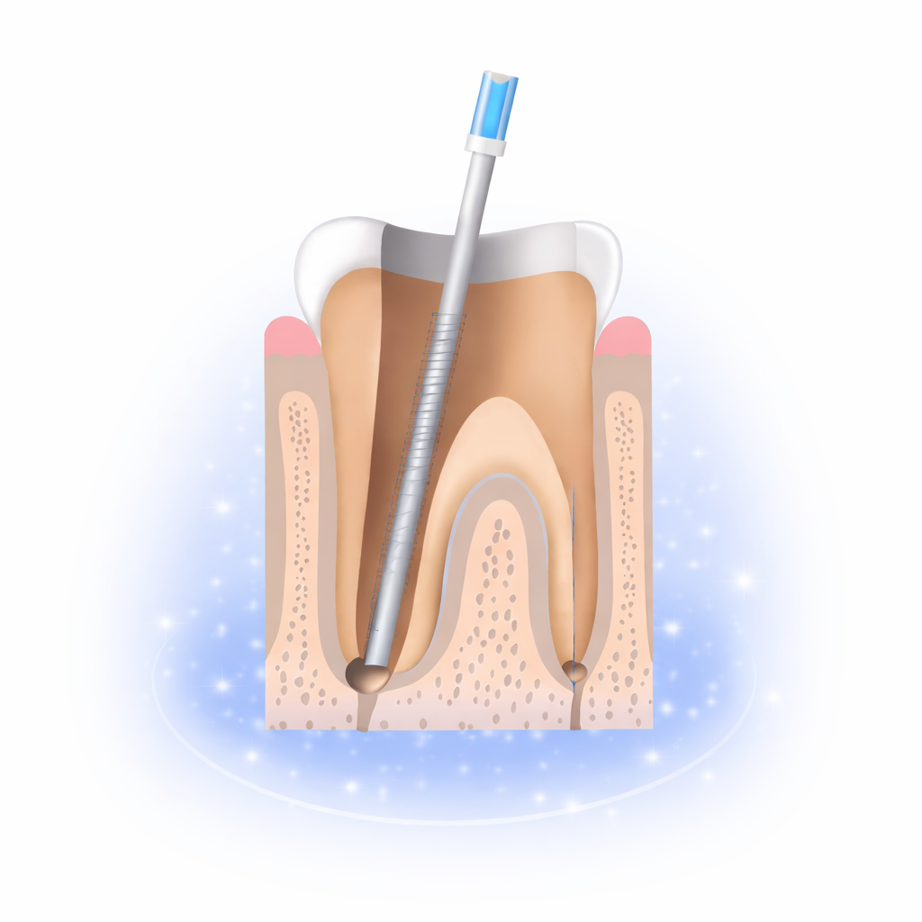 علاج عصب الأسنان gallery image 4