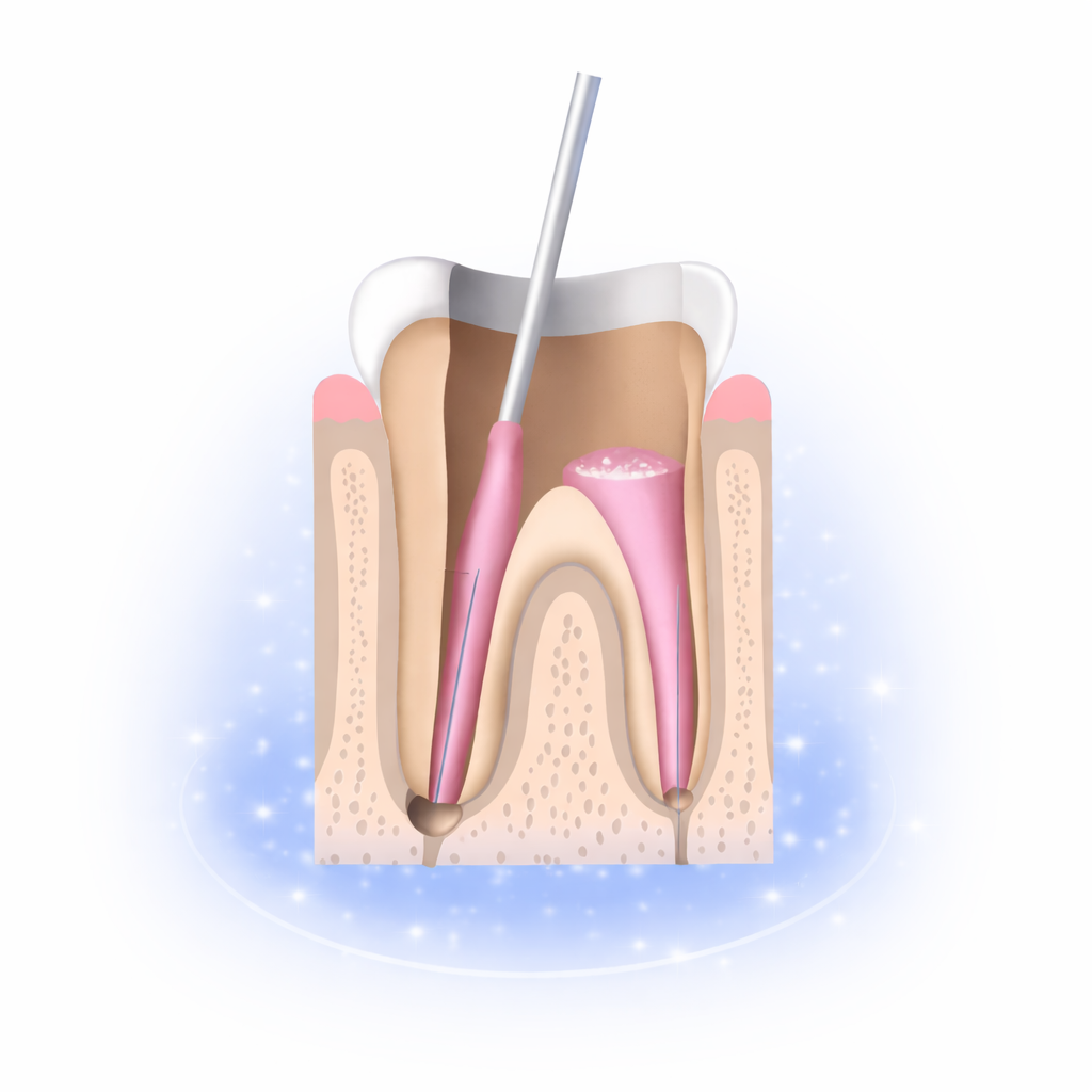 علاج عصب الأسنان gallery image 3