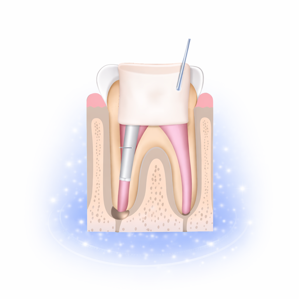علاج عصب الأسنان gallery image 2