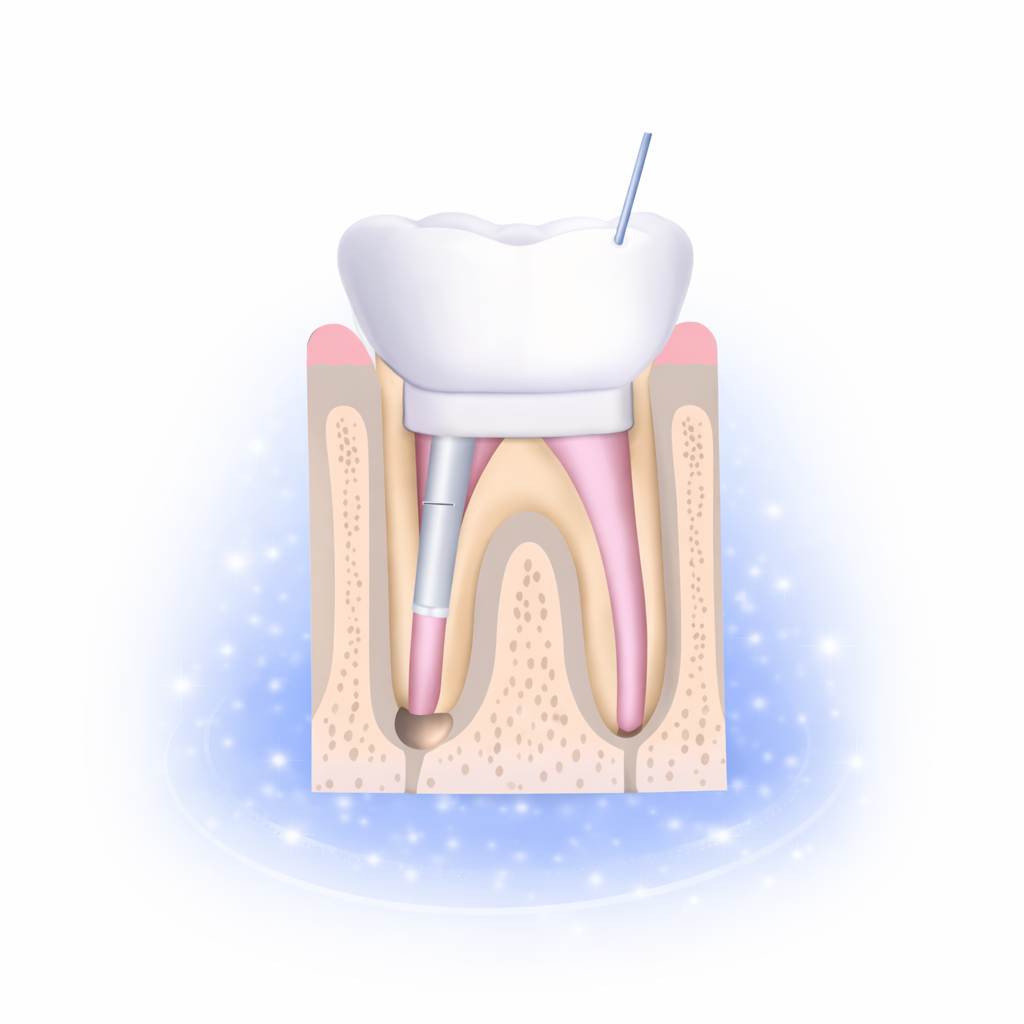 علاج عصب الأسنان gallery image 1